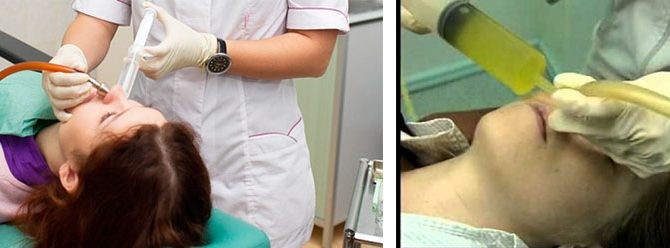 Лечение гайморита с помощью методики «Кукушка» Лечение гайморита с помощью методики «Кукушка»