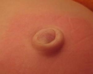 Грыжа пупка у взрослых и у ребенка Грыжа пупка у взрослых и у ребенка