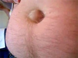 Грыжа пупка у взрослых и у ребенка Грыжа пупка у взрослых и у ребенка