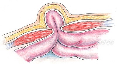 Грыжа пупка у взрослых и у ребенка Грыжа пупка у взрослых и у ребенка