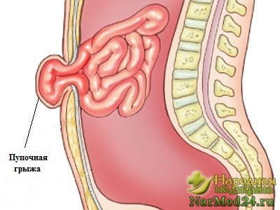 Грыжа пупка у взрослых и у ребенка Грыжа пупка у взрослых и у ребенка