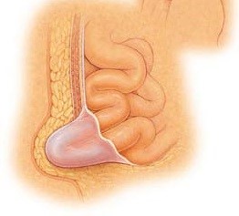 Грыжа пупка у взрослых и у ребенка Грыжа пупка у взрослых и у ребенка