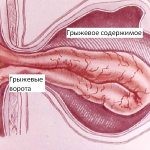 Грыжа пупка у взрослых и у ребенка Грыжа пупка у взрослых и у ребенка