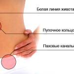 Грыжа пупка у взрослых и у ребенка Грыжа пупка у взрослых и у ребенка