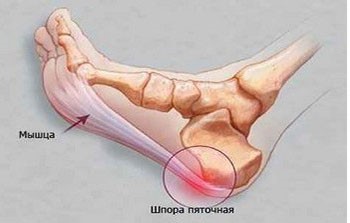 Мазь для лечения пяточной шпоры: чем мазать пятки Мазь для лечения пяточной шпоры: чем мазать пятки
