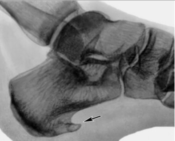 Мазь для лечения пяточной шпоры: чем мазать пятки Мазь для лечения пяточной шпоры: чем мазать пятки