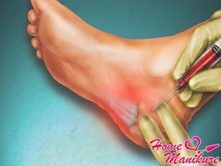Как можно избавиться от пяточной шпоры? Как можно избавиться от пяточной шпоры?