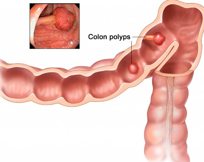Признаки, прогноз и лечение рака двенадцатиперстной кишки Признаки, прогноз и лечение рака двенадцатиперстной кишки