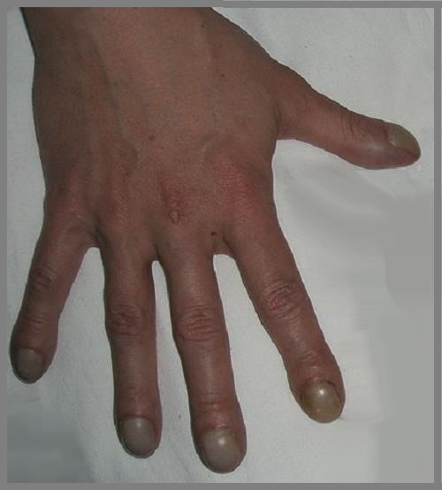 Проявления рака легких у мужчин и женщин Проявления рака легких у мужчин и женщин