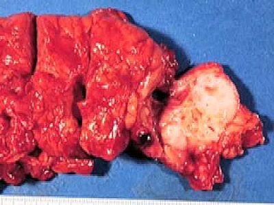 Проявления рака поджелудочной железы: симптомы и признаки Проявления рака поджелудочной железы: симптомы и признаки