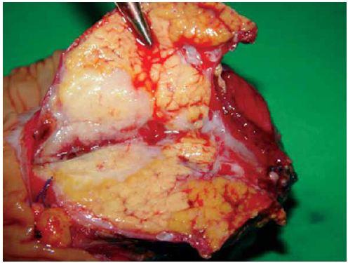 Проявления рака поджелудочной железы: симптомы и признаки Проявления рака поджелудочной железы: симптомы и признаки