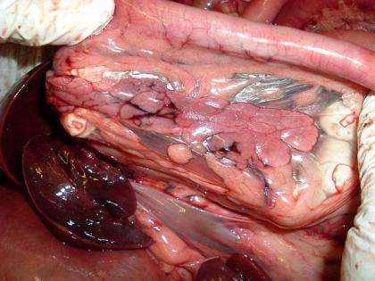 Проявления рака поджелудочной железы: симптомы и признаки Проявления рака поджелудочной железы: симптомы и признаки