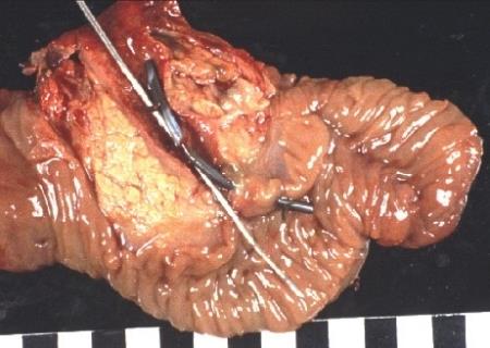 Проявления рака поджелудочной железы: симптомы и признаки Проявления рака поджелудочной железы: симптомы и признаки