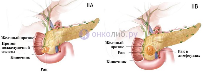 Прогноз при раке поджелудочной в зависимости от стадии Прогноз при раке поджелудочной в зависимости от стадии