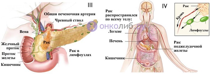 Прогноз при раке поджелудочной в зависимости от стадии Прогноз при раке поджелудочной в зависимости от стадии
