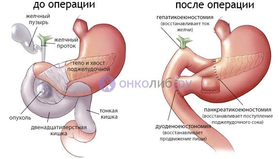 Прогноз при раке поджелудочной в зависимости от стадии Прогноз при раке поджелудочной в зависимости от стадии