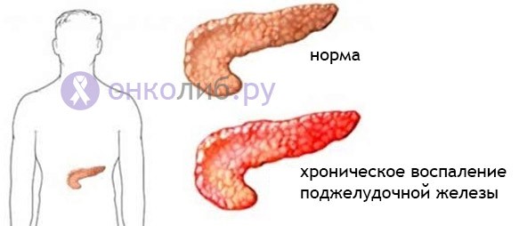 Прогноз при раке поджелудочной в зависимости от стадии Прогноз при раке поджелудочной в зависимости от стадии