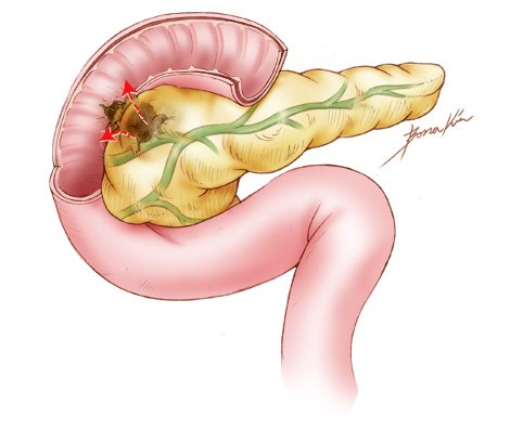 Прогноз при раке поджелудочной в зависимости от стадии Прогноз при раке поджелудочной в зависимости от стадии