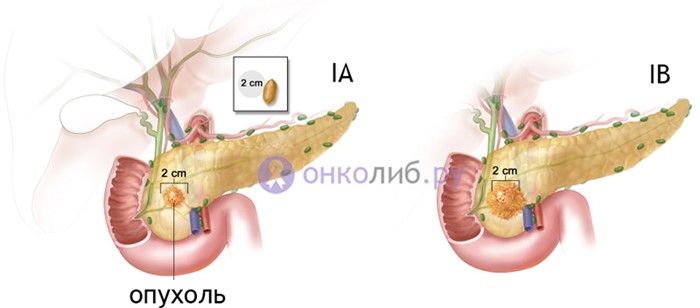 Прогноз при раке поджелудочной в зависимости от стадии Прогноз при раке поджелудочной в зависимости от стадии
