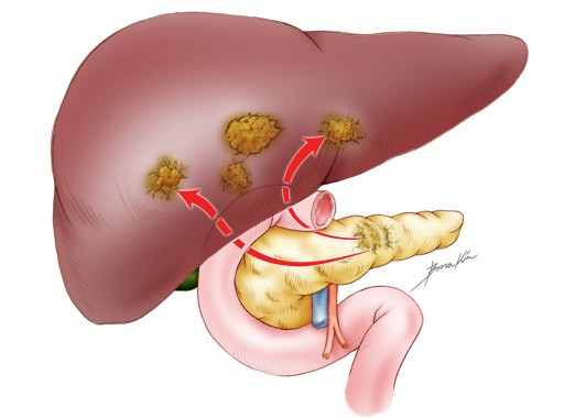Прогноз при раке поджелудочной в зависимости от стадии Прогноз при раке поджелудочной в зависимости от стадии