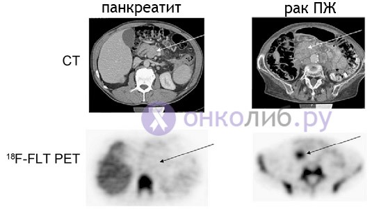 Прогноз при раке поджелудочной в зависимости от стадии Прогноз при раке поджелудочной в зависимости от стадии