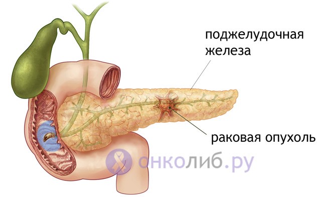 Прогноз при раке поджелудочной в зависимости от стадии Прогноз при раке поджелудочной в зависимости от стадии