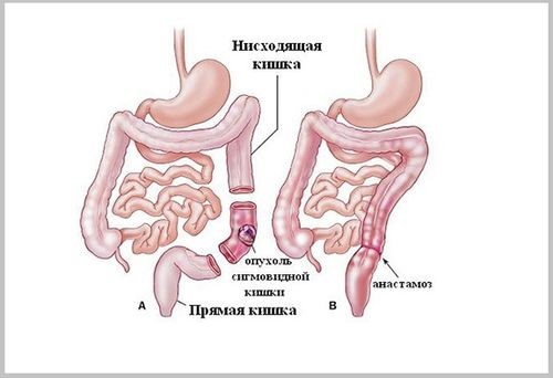 Стадии и симптомы рака сигмовидной кишки Стадии и симптомы рака сигмовидной кишки