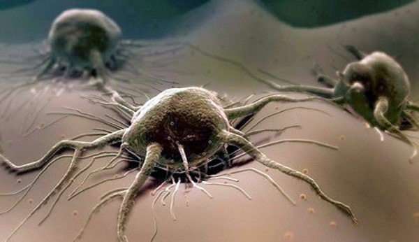 Какие симптомы при опухоли слепой кишки? Какие симптомы при опухоли слепой кишки?