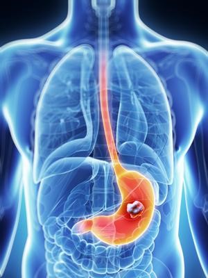 Как исцелить аденокарциному желудка? Как исцелить аденокарциному желудка?