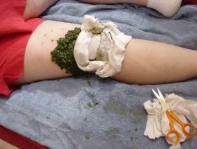 Полная характеристика ревматоидного артрита у детей: причины, симптомы, лечение Полная характеристика ревматоидного артрита у детей: причины, симптомы, лечение