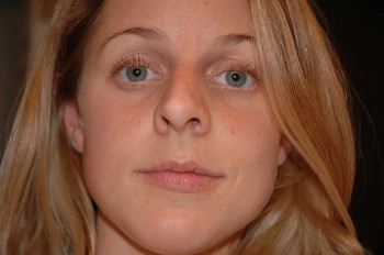 Септопластика носовой перегородки Септопластика носовой перегородки