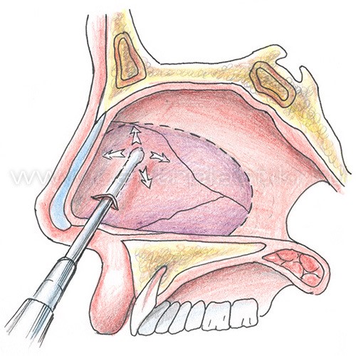 Септопластика носовой перегородки Септопластика носовой перегородки