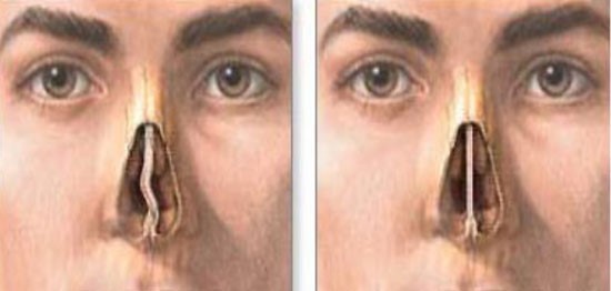 Септопластика носовой перегородки Септопластика носовой перегородки