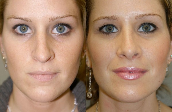 Септопластика носовой перегородки Септопластика носовой перегородки