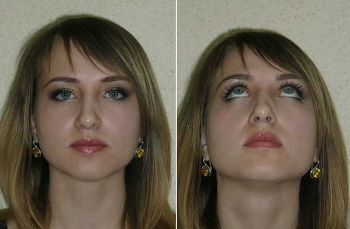 Септопластика носовой перегородки Септопластика носовой перегородки