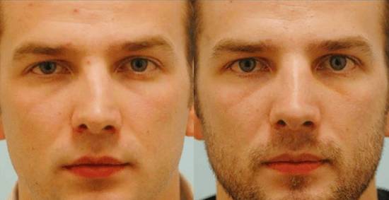 Септопластика носовой перегородки Септопластика носовой перегородки