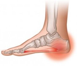 Чем можно лечить пяточную шпору дома? Чем можно лечить пяточную шпору дома?
