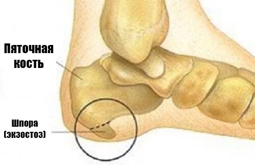Чем можно лечить пяточную шпору дома? Чем можно лечить пяточную шпору дома?