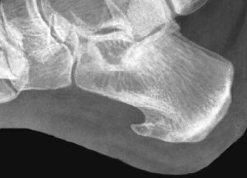 Чем можно лечить пяточную шпору дома? Чем можно лечить пяточную шпору дома?