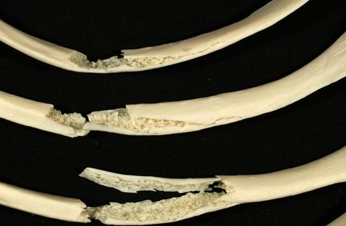 Правила оказания первой помощи при переломе ребер Правила оказания первой помощи при переломе ребер