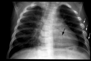 Правила оказания первой помощи при переломе ребер Правила оказания первой помощи при переломе ребер