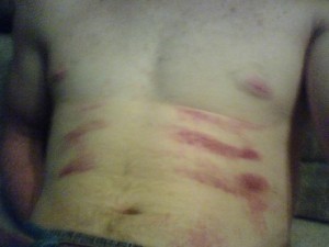 Правила оказания первой помощи при переломе ребер Правила оказания первой помощи при переломе ребер