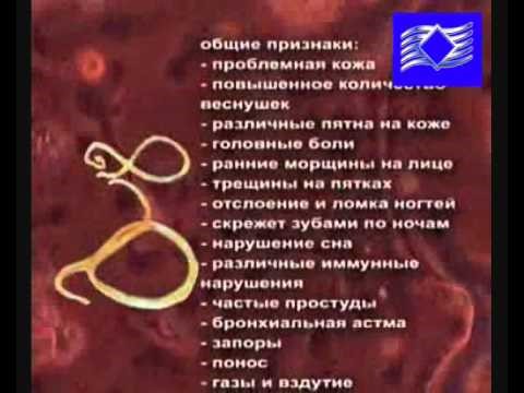Определение заражения - как выглядят человеческие глисты? Определение заражения - как выглядят человеческие глисты?