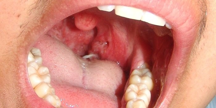 Симптомы и проявления болезней горла : УхоНос.ру Симптомы и проявления болезней горла : УхоНос.ру