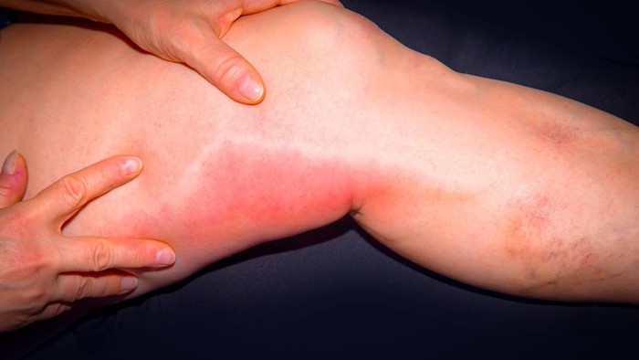 Особенности тромбофлебита поверхностных вен на ногах Особенности тромбофлебита поверхностных вен на ногах