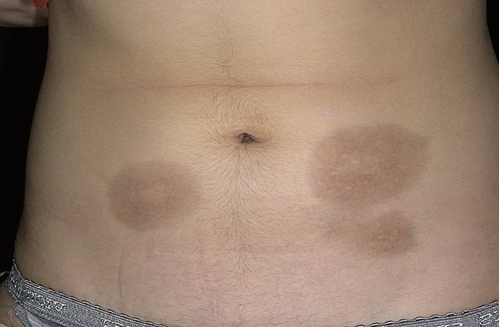 Склеродермия: системная, очаговая - лечение, симптомы Склеродермия: системная, очаговая - лечение, симптомы