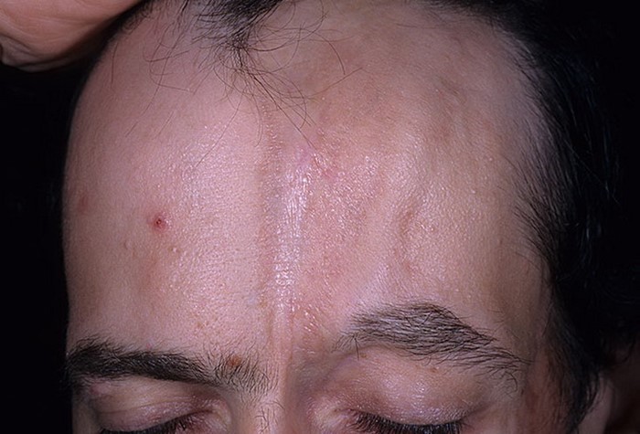 Склеродермия: системная, очаговая - лечение, симптомы Склеродермия: системная, очаговая - лечение, симптомы