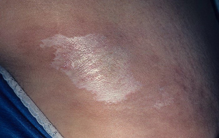 Склеродермия: системная, очаговая - лечение, симптомы Склеродермия: системная, очаговая - лечение, симптомы