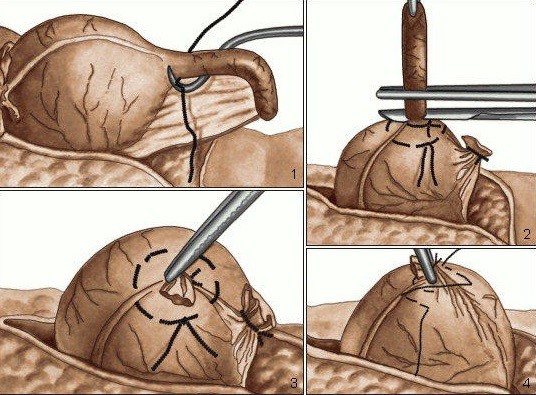 Как вырезают аппендицит и сколько длится операция по его удалению Как вырезают аппендицит и сколько длится операция по его удалению