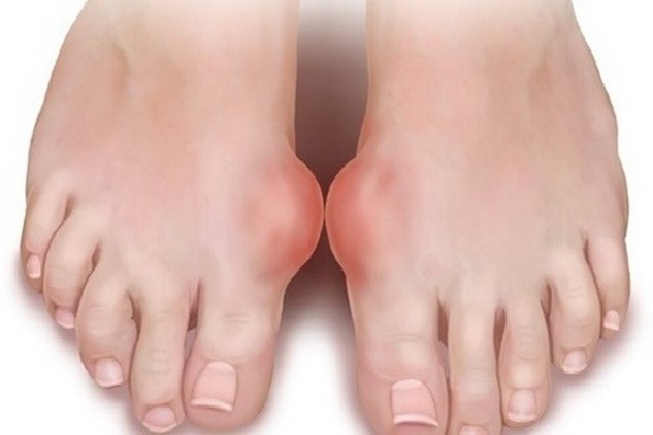 Проявление подагры её осложнения и лечение недуга содой Проявление подагры её осложнения и лечение недуга содой